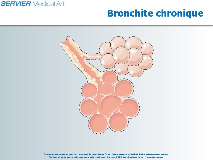 Bronchite chronique Utilisation non commerciale uniquement. Les images de Servier Medical Art sont téléchargeables