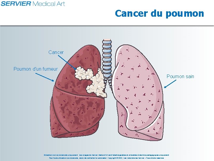 Cancer du poumon Cancer Poumon d’un fumeur Poumon sain Utilisation non commerciale uniquement. Les