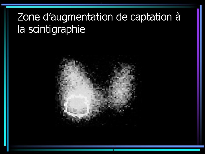 Zone d’augmentation de captation à la scintigraphie Zone d’augmentation de captation à la scintigraphie