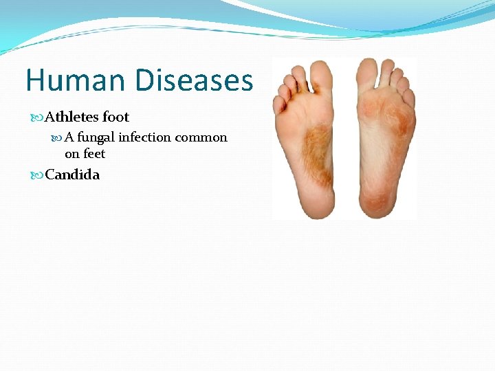 Human Diseases Athletes foot A fungal infection common on feet Candida 