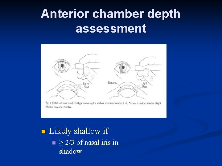 Anterior chamber depth assessment n Likely shallow if n ≥ 2/3 of nasal iris