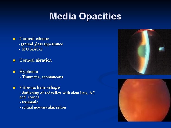 Media Opacities n Corneal edema: - ground glass appearance - R/O AACG n Corneal