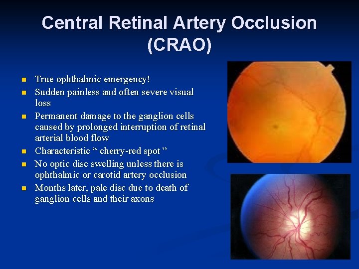 Central Retinal Artery Occlusion (CRAO) n n n True ophthalmic emergency! Sudden painless and