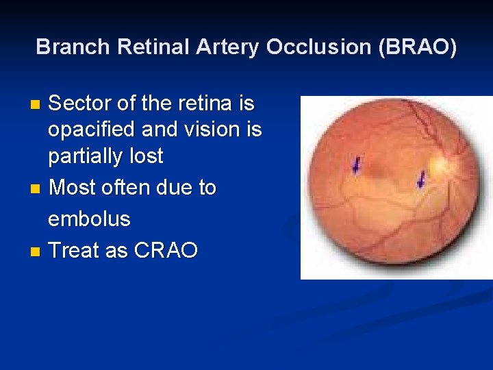 Branch Retinal Artery Occlusion (BRAO) Sector of the retina is opacified and vision is