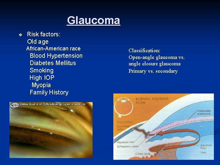 Glaucoma v Risk factors: Old age African-American race Blood Hypertension Diabetes Mellitus Smoking High