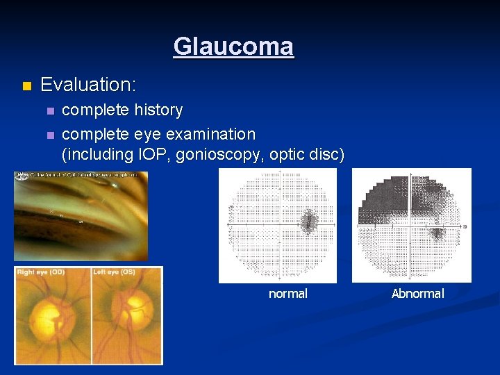 Glaucoma n Evaluation: n n n complete history complete eye examination (including IOP, gonioscopy,