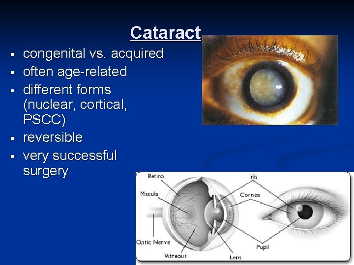 Cataract § § § congenital vs. acquired often age-related different forms (nuclear, cortical, PSCC)