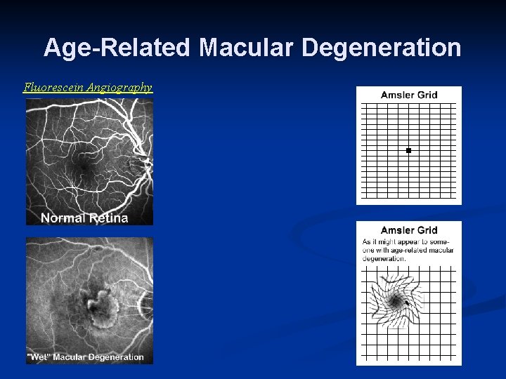 Age-Related Macular Degeneration Fluorescein Angiography 