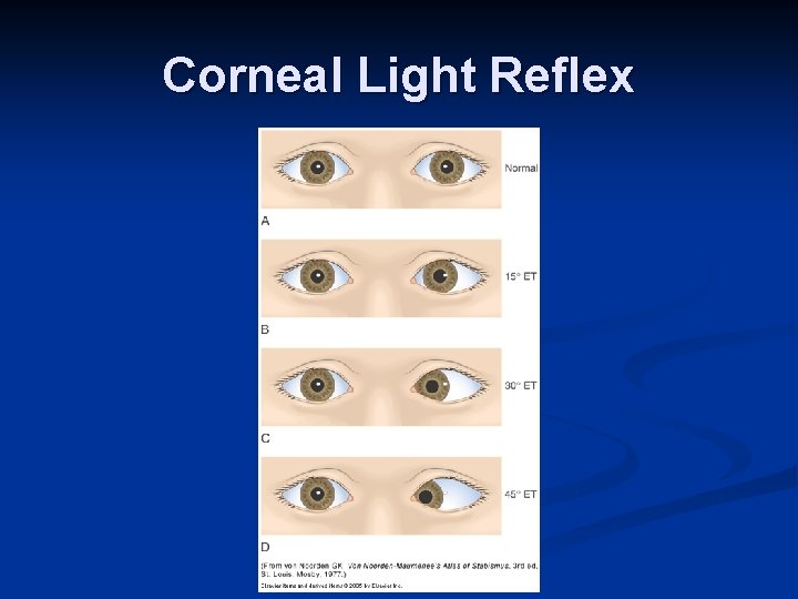 Corneal Light Reflex 