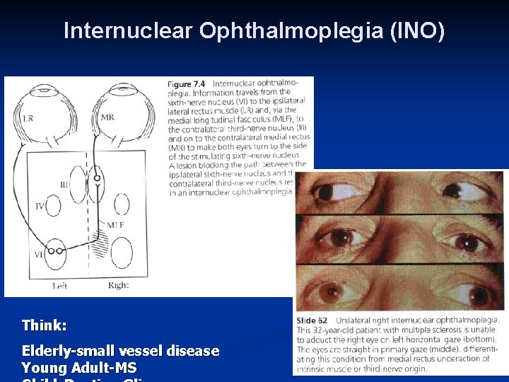Internuclear Ophthalmoplegia (INO) Think: Elderly-small vessel disease Young Adult-MS 