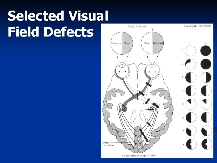 Selected Visual Field Defects 