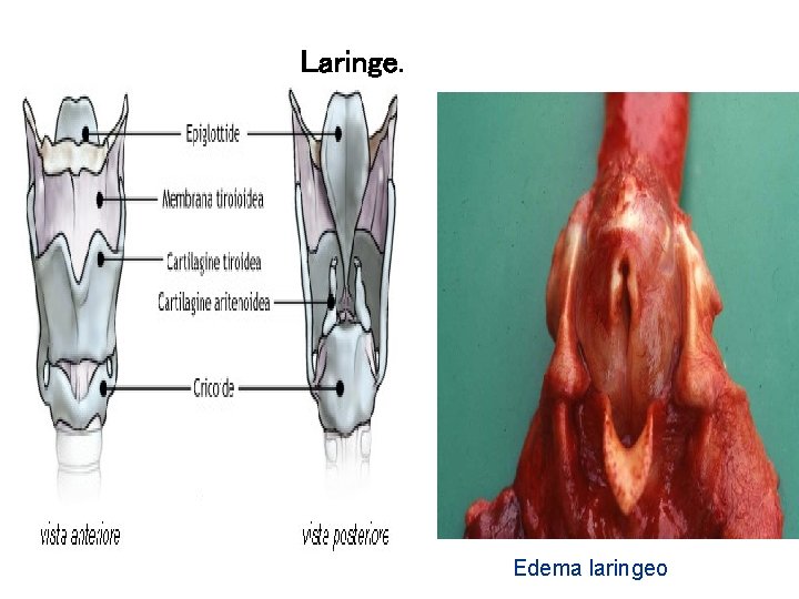 Laringe. Edema laringeo 