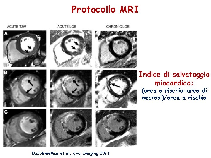 Protocollo MRI Indice di salvataggio miocardico: (area a rischio-area di necrosi)/area a rischio Dall’Armellina