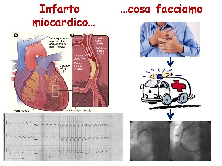 Infarto miocardico… …cosa facciamo 