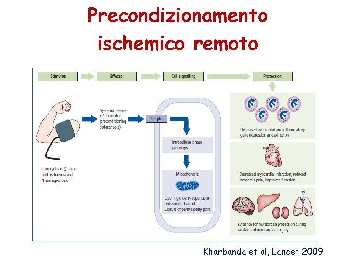 Precondizionamento ischemico remoto Kharbanda et al, Lancet 2009 