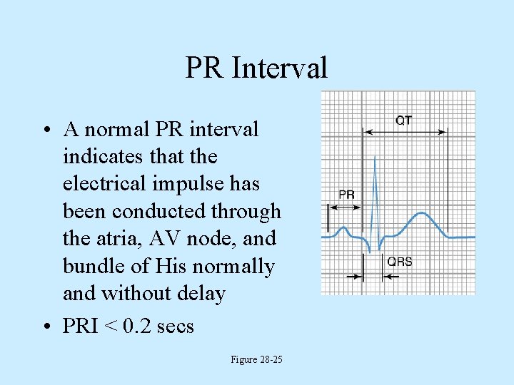 PR Interval • A normal PR interval indicates that the electrical impulse has been