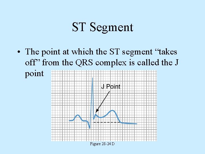 ST Segment • The point at which the ST segment “takes off” from the