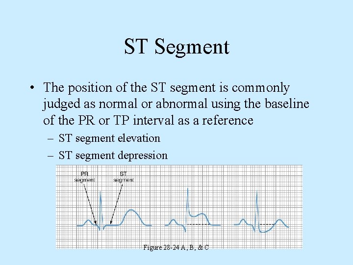 ST Segment • The position of the ST segment is commonly judged as normal