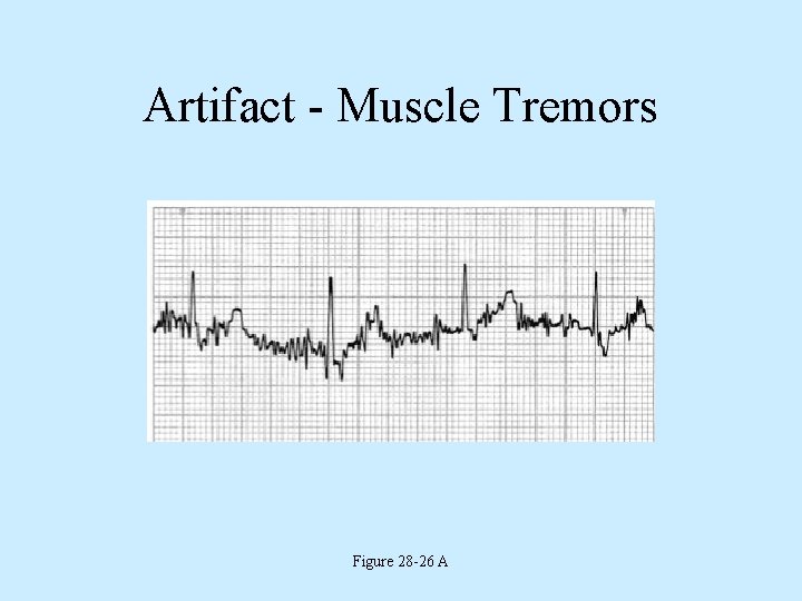 Artifact - Muscle Tremors Figure 28 -26 A 