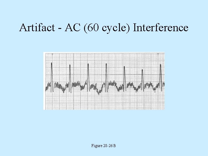 Artifact - AC (60 cycle) Interference Figure 28 -26 B 