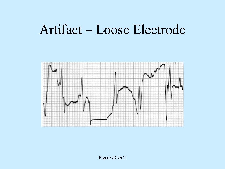 Artifact – Loose Electrode Figure 28 -26 C 