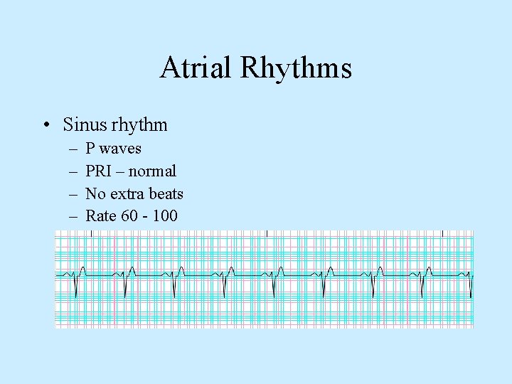 Atrial Rhythms • Sinus rhythm – – P waves PRI – normal No extra