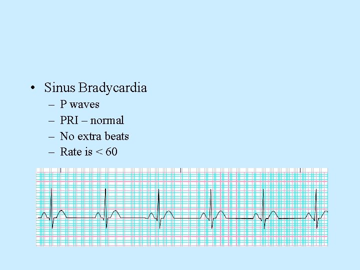  • Sinus Bradycardia – – P waves PRI – normal No extra beats