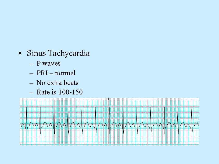  • Sinus Tachycardia – – P waves PRI – normal No extra beats