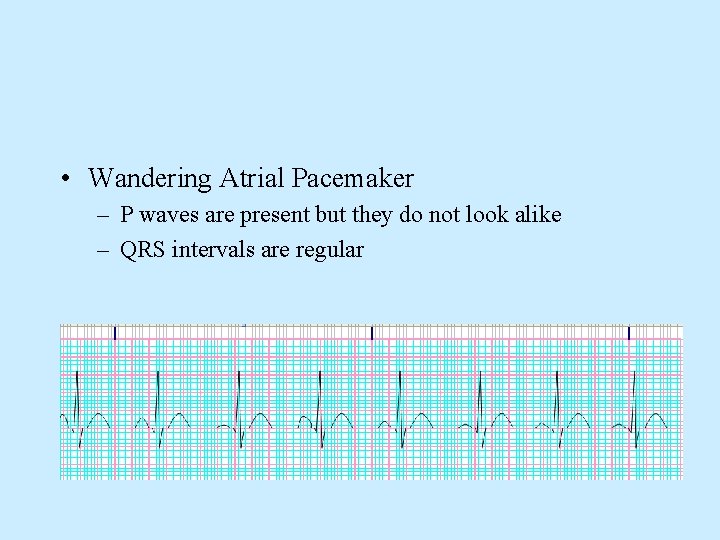  • Wandering Atrial Pacemaker – P waves are present but they do not