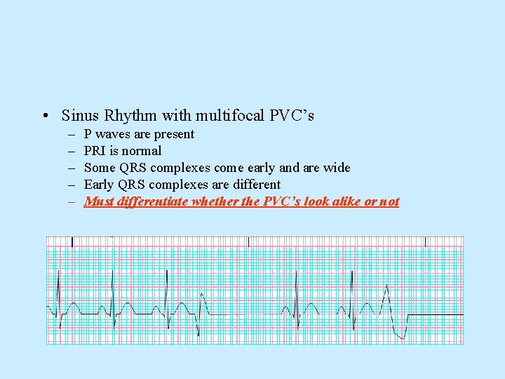  • Sinus Rhythm with multifocal PVC’s – – – P waves are present