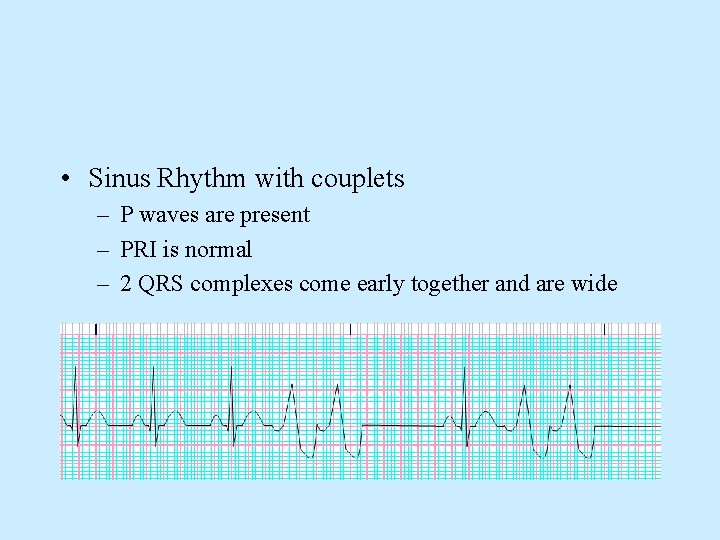  • Sinus Rhythm with couplets – P waves are present – PRI is