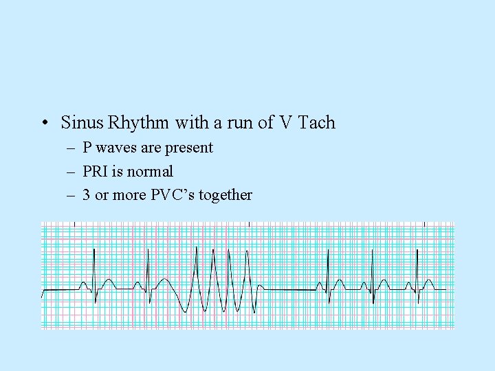  • Sinus Rhythm with a run of V Tach – P waves are