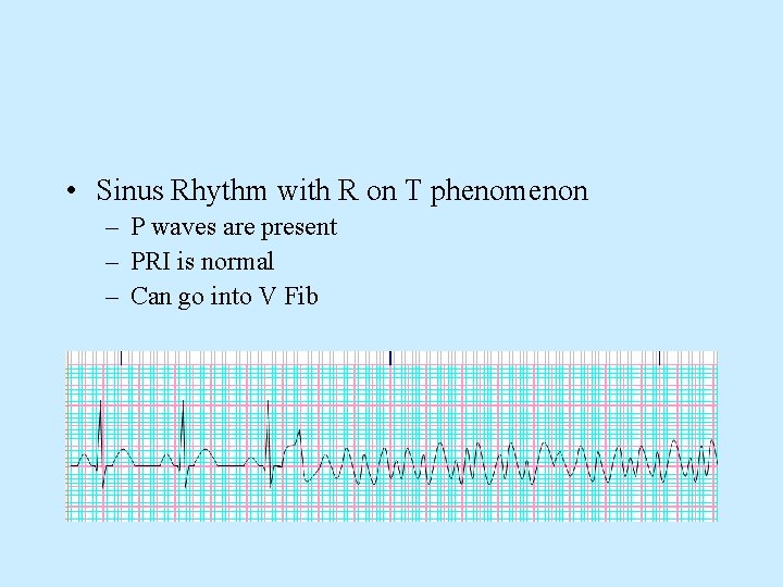  • Sinus Rhythm with R on T phenomenon – P waves are present