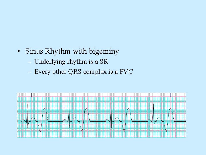  • Sinus Rhythm with bigeminy – Underlying rhythm is a SR – Every