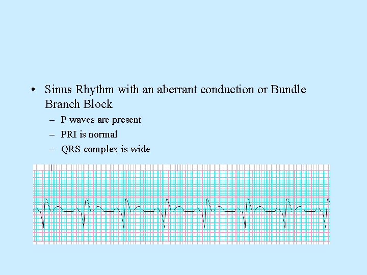  • Sinus Rhythm with an aberrant conduction or Bundle Branch Block – P