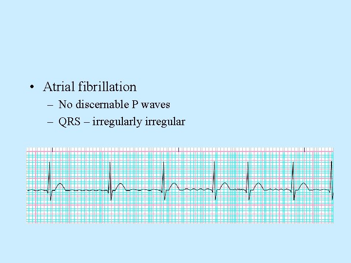  • Atrial fibrillation – No discernable P waves – QRS – irregularly irregular