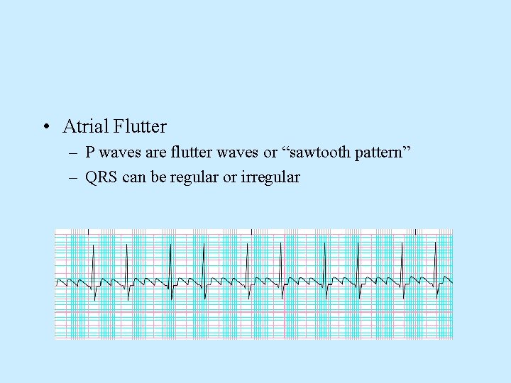  • Atrial Flutter – P waves are flutter waves or “sawtooth pattern” –