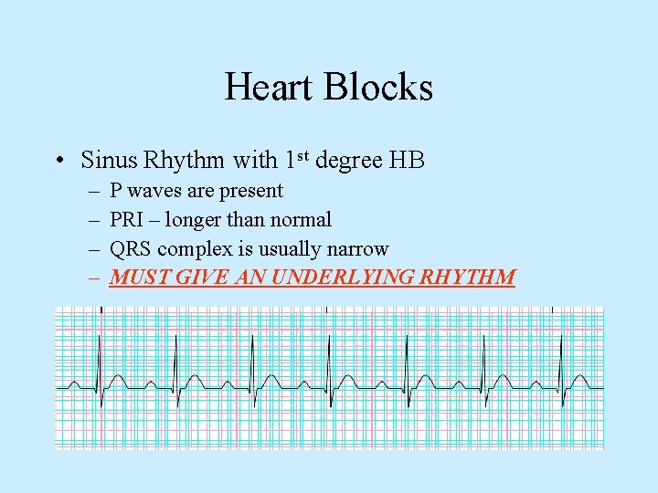 Heart Blocks • Sinus Rhythm with 1 st degree HB – – P waves