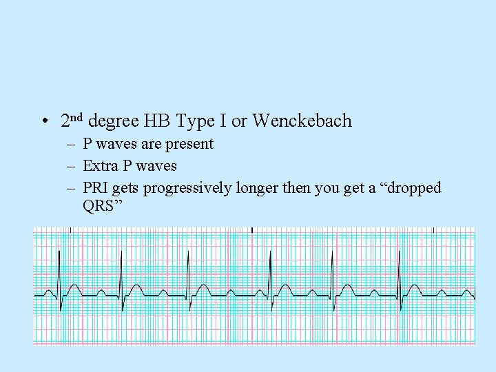  • 2 nd degree HB Type I or Wenckebach – P waves are