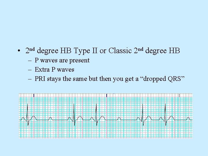  • 2 nd degree HB Type II or Classic 2 nd degree HB