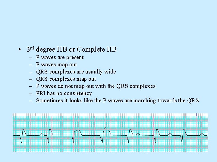  • 3 rd degree HB or Complete HB – – – – P