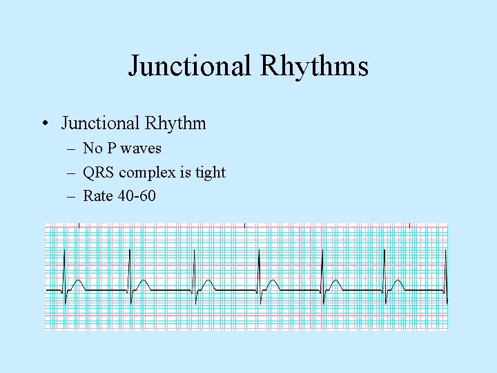 Junctional Rhythms • Junctional Rhythm – No P waves – QRS complex is tight
