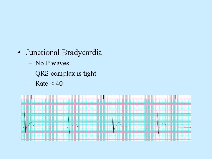  • Junctional Bradycardia – No P waves – QRS complex is tight –