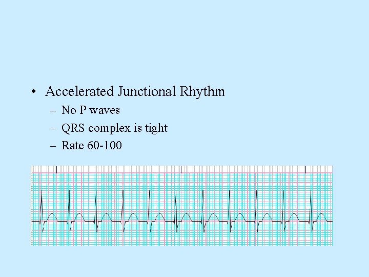  • Accelerated Junctional Rhythm – No P waves – QRS complex is tight