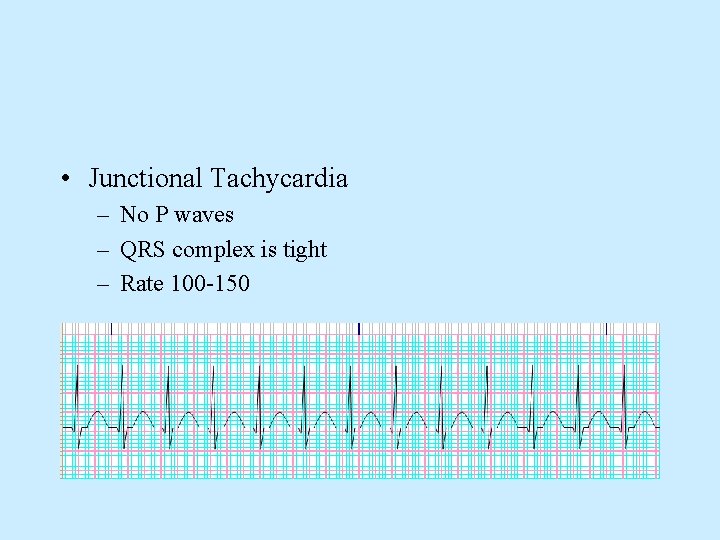  • Junctional Tachycardia – No P waves – QRS complex is tight –