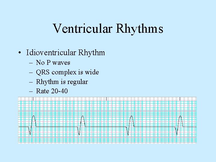 Ventricular Rhythms • Idioventricular Rhythm – – No P waves QRS complex is wide