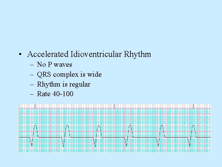  • Accelerated Idioventricular Rhythm – – No P waves QRS complex is wide