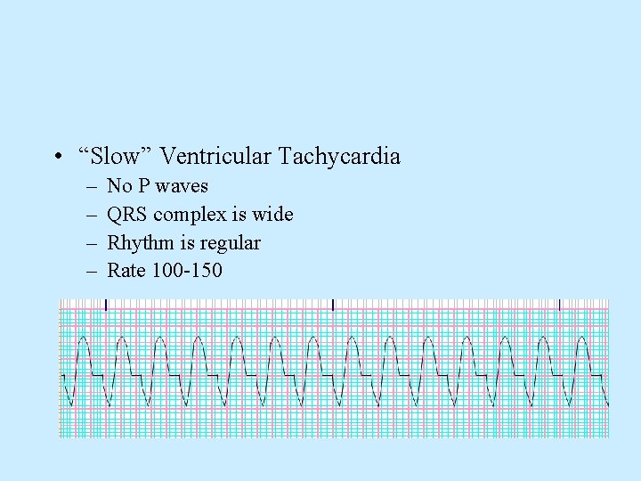  • “Slow” Ventricular Tachycardia – – No P waves QRS complex is wide