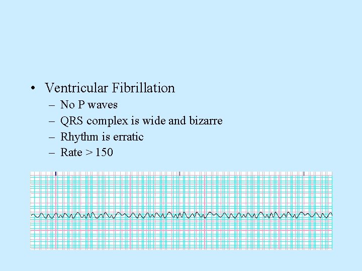  • Ventricular Fibrillation – – No P waves QRS complex is wide and
