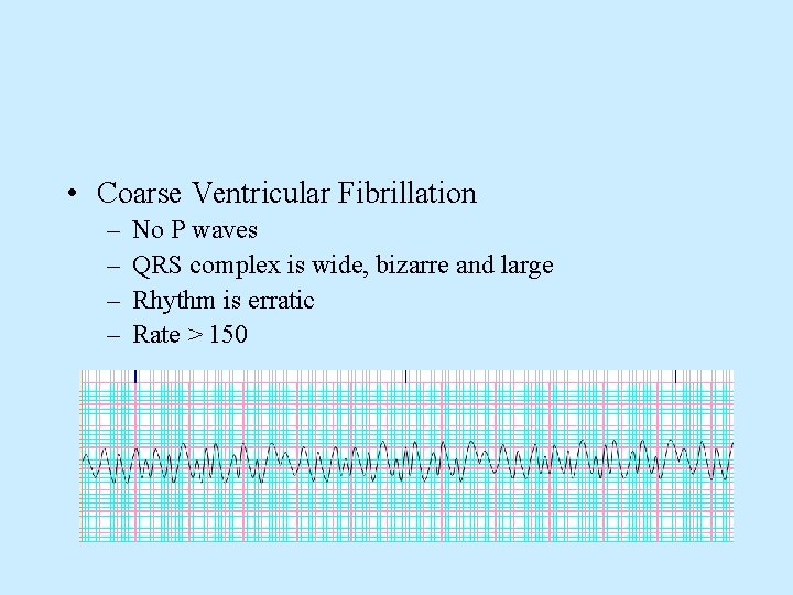  • Coarse Ventricular Fibrillation – – No P waves QRS complex is wide,